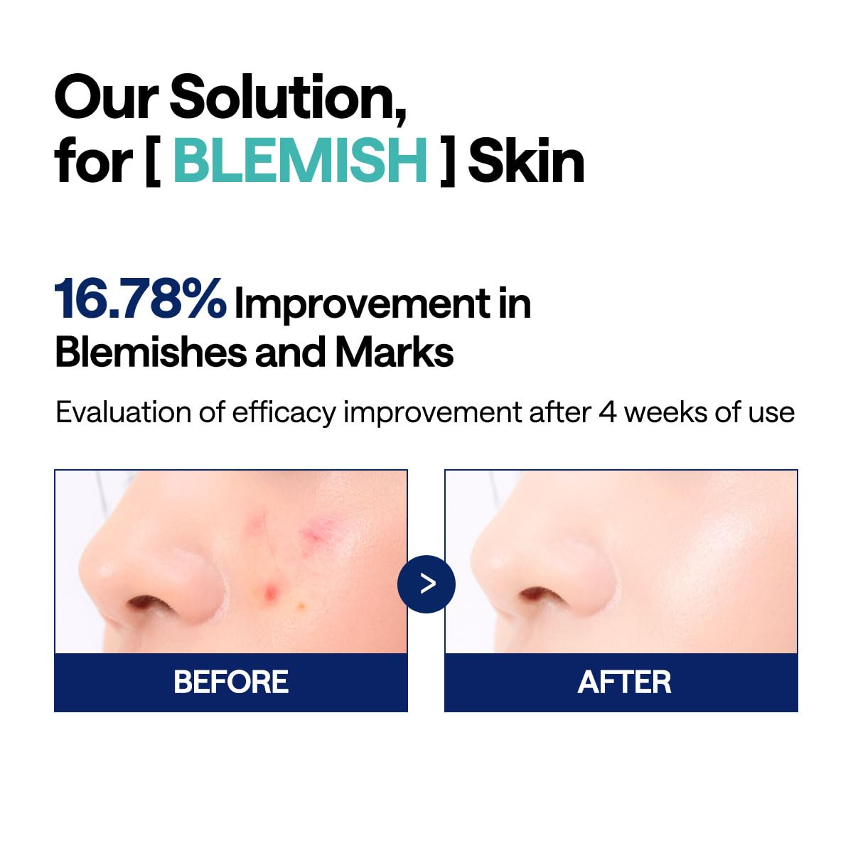 Mediheal Madecassoside Blemish Toner Pad – Calming Vegan Pads with Centella Asiatica for Acne-Prone Skin