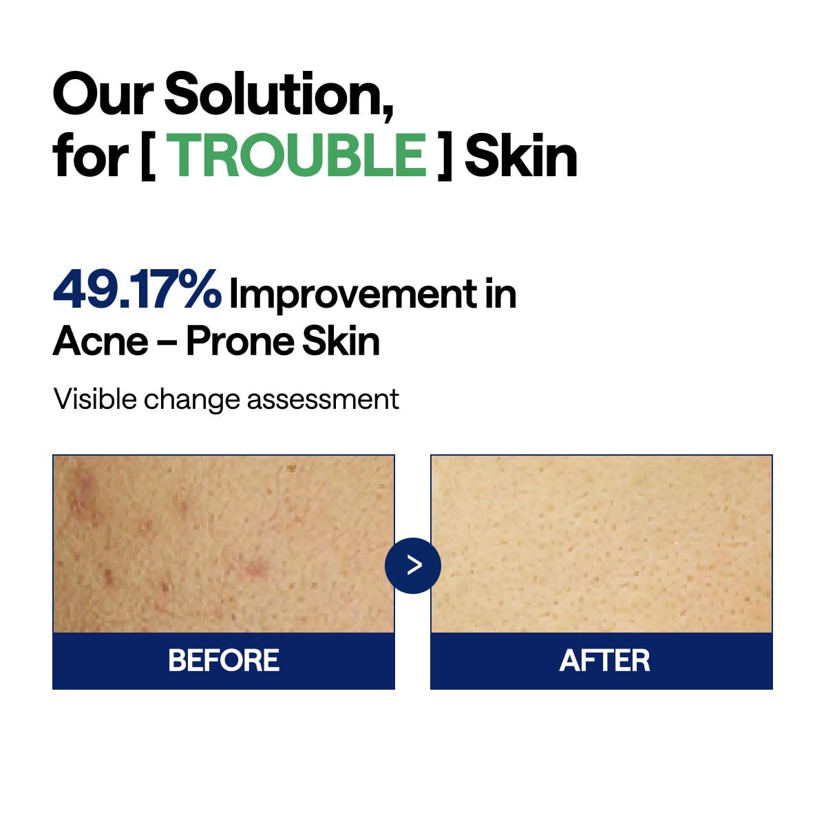 Mediheal Teatree Trouble Toner Pad – Calming & Soothing Vegan Gauze Pads for Acne-Prone Skin